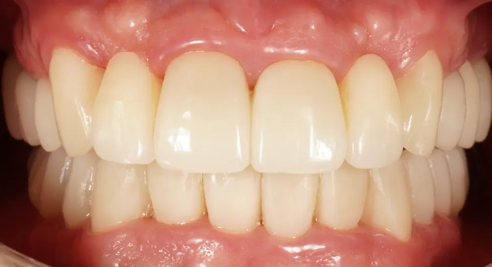 After ortho treatment