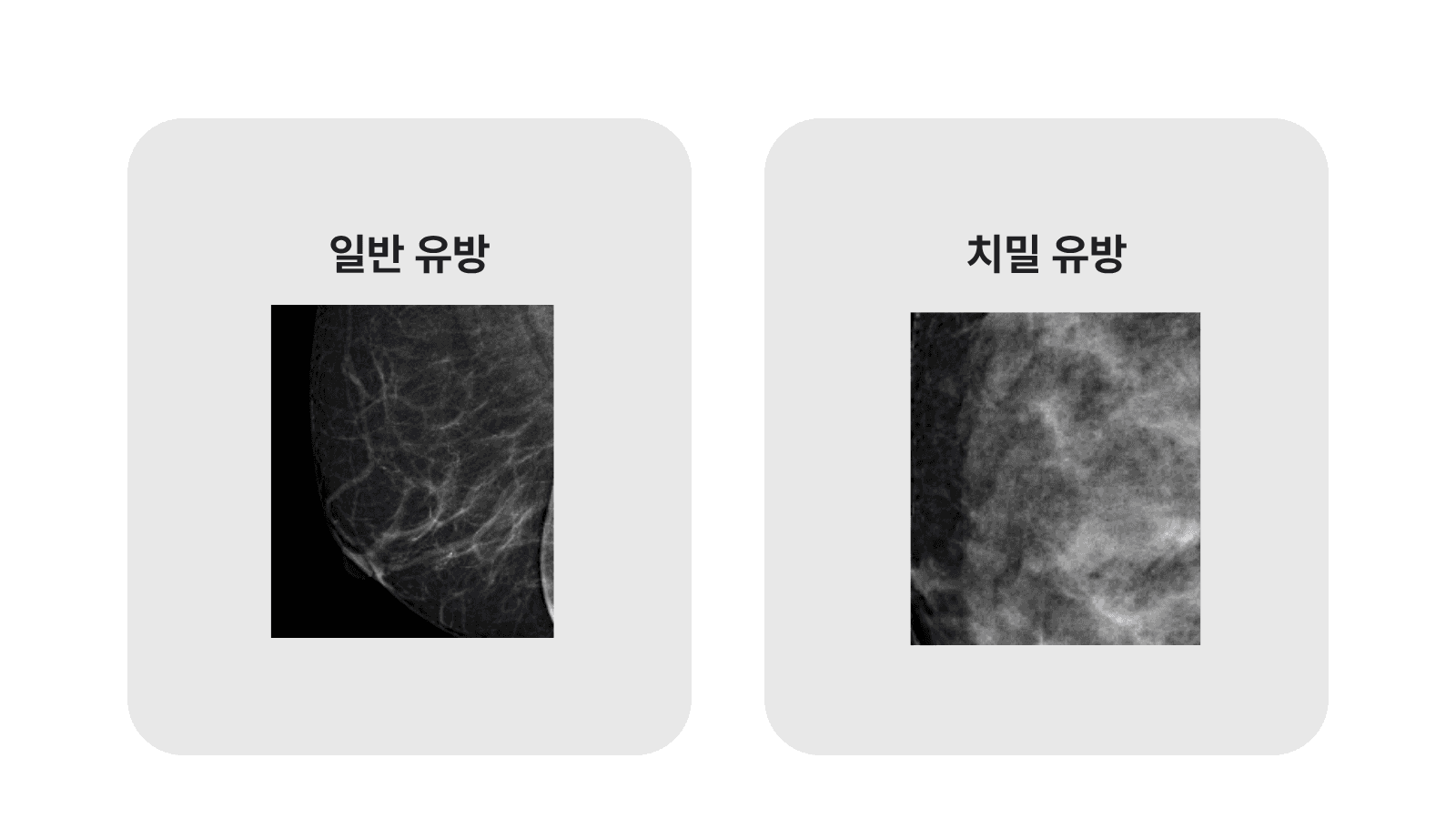치밀유방과 일반유방(지방형 유방)의 맘모그래피 영상 비교 인포그래픽