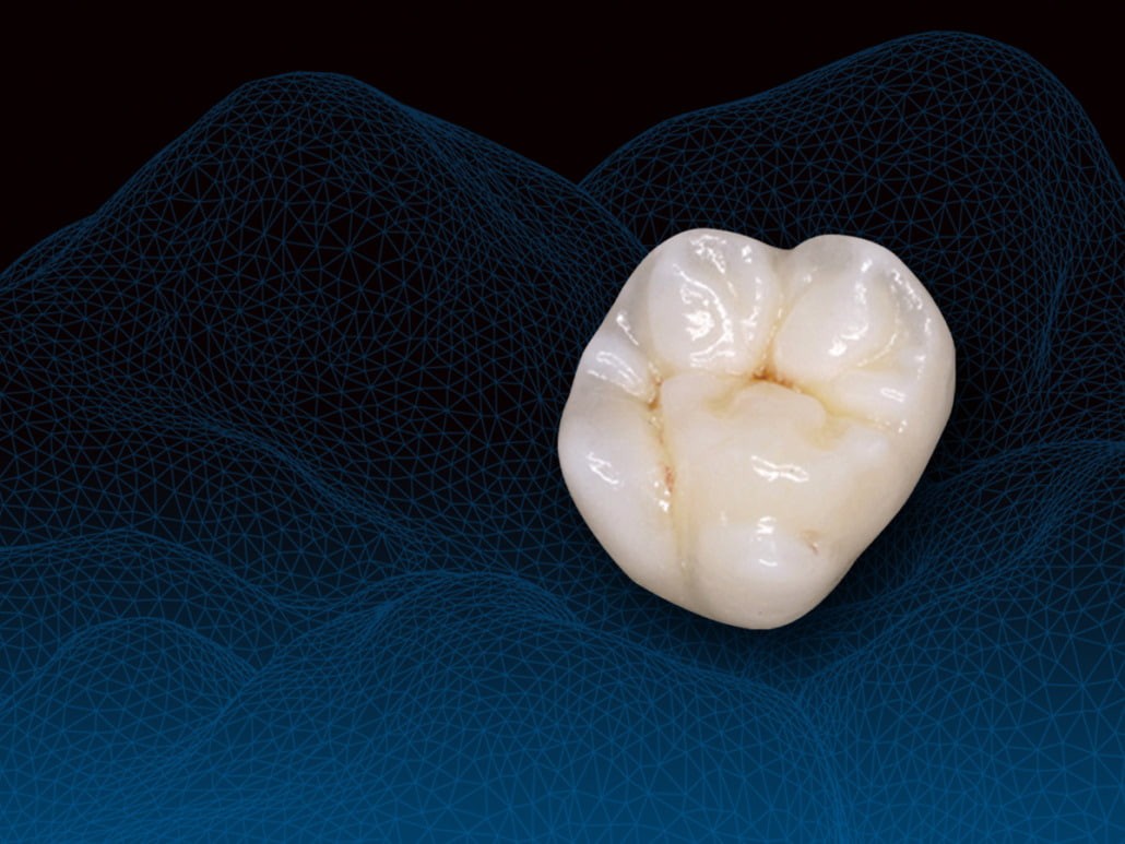 Zirconia crown in oral nexus, coimbatore