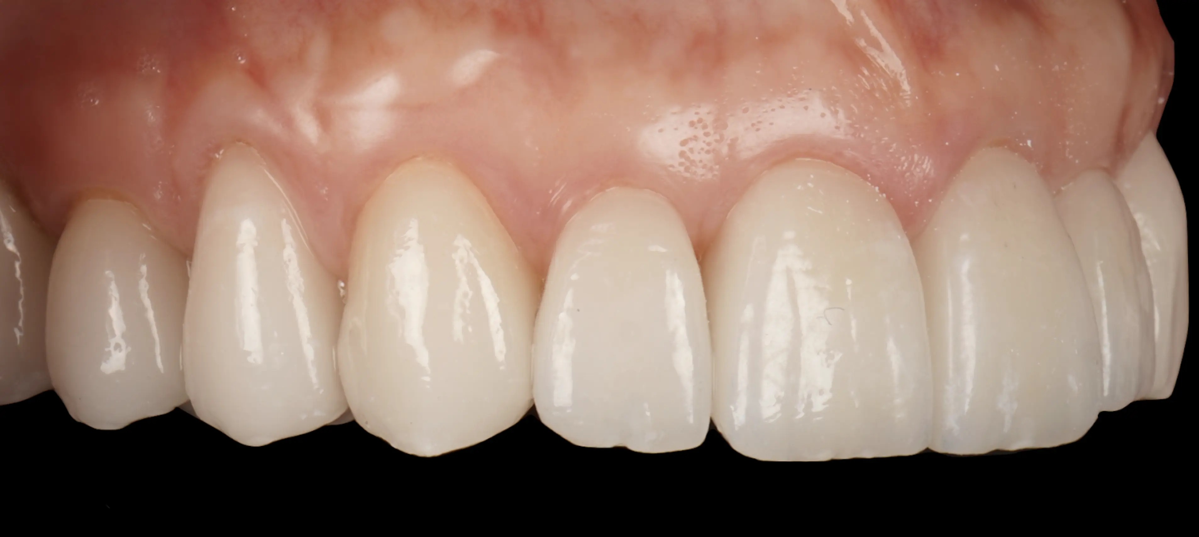 Veneers and crowns (case 2)