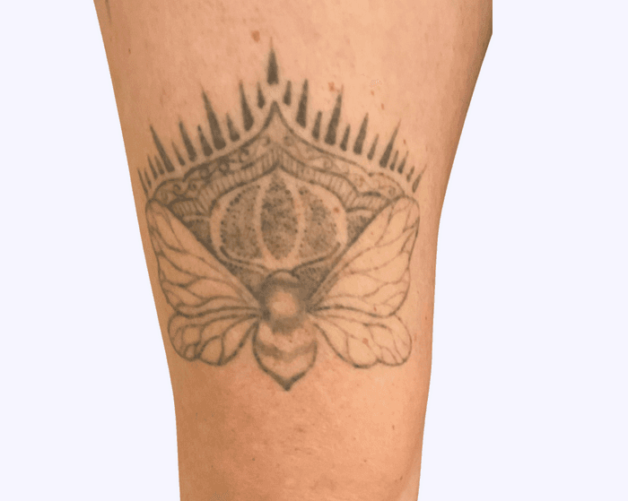 Female, 3 sessions before treatment