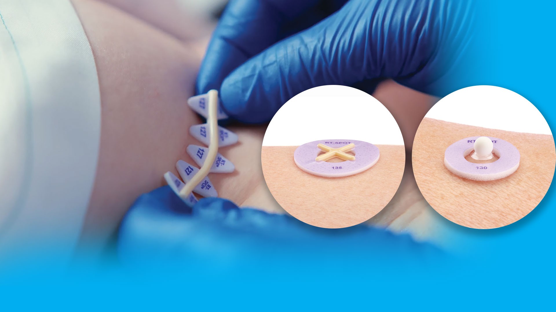 RT-SPOT Banner - RT-SPOT elevated skin marker applied to skin