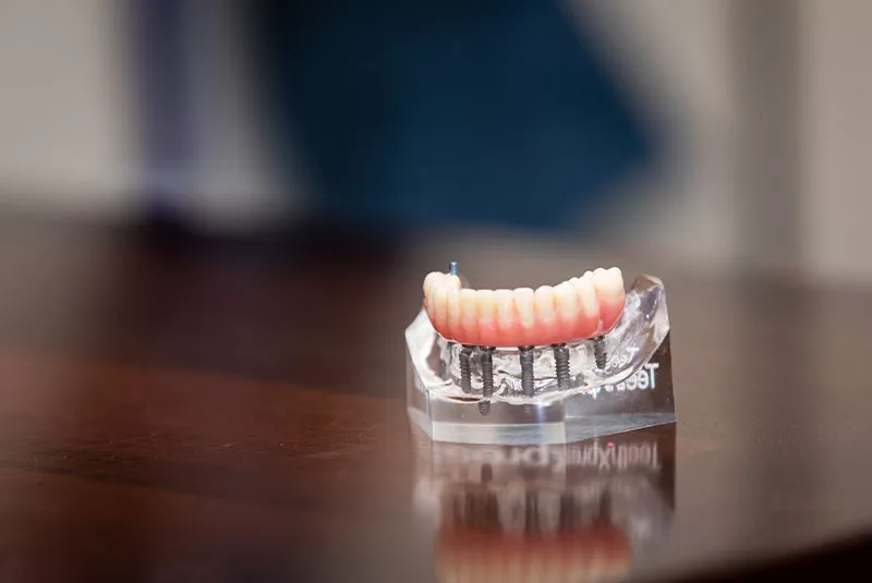  Implant-Supported Dentures