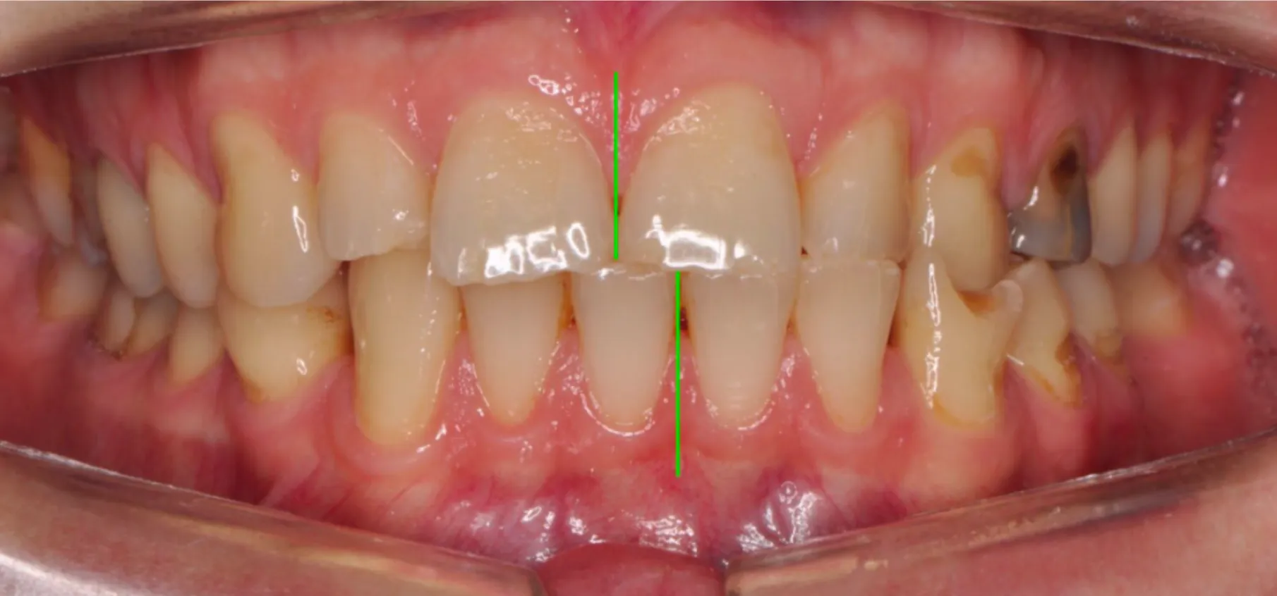 Harmonised occlusion and aesthetic restorations. No surgery