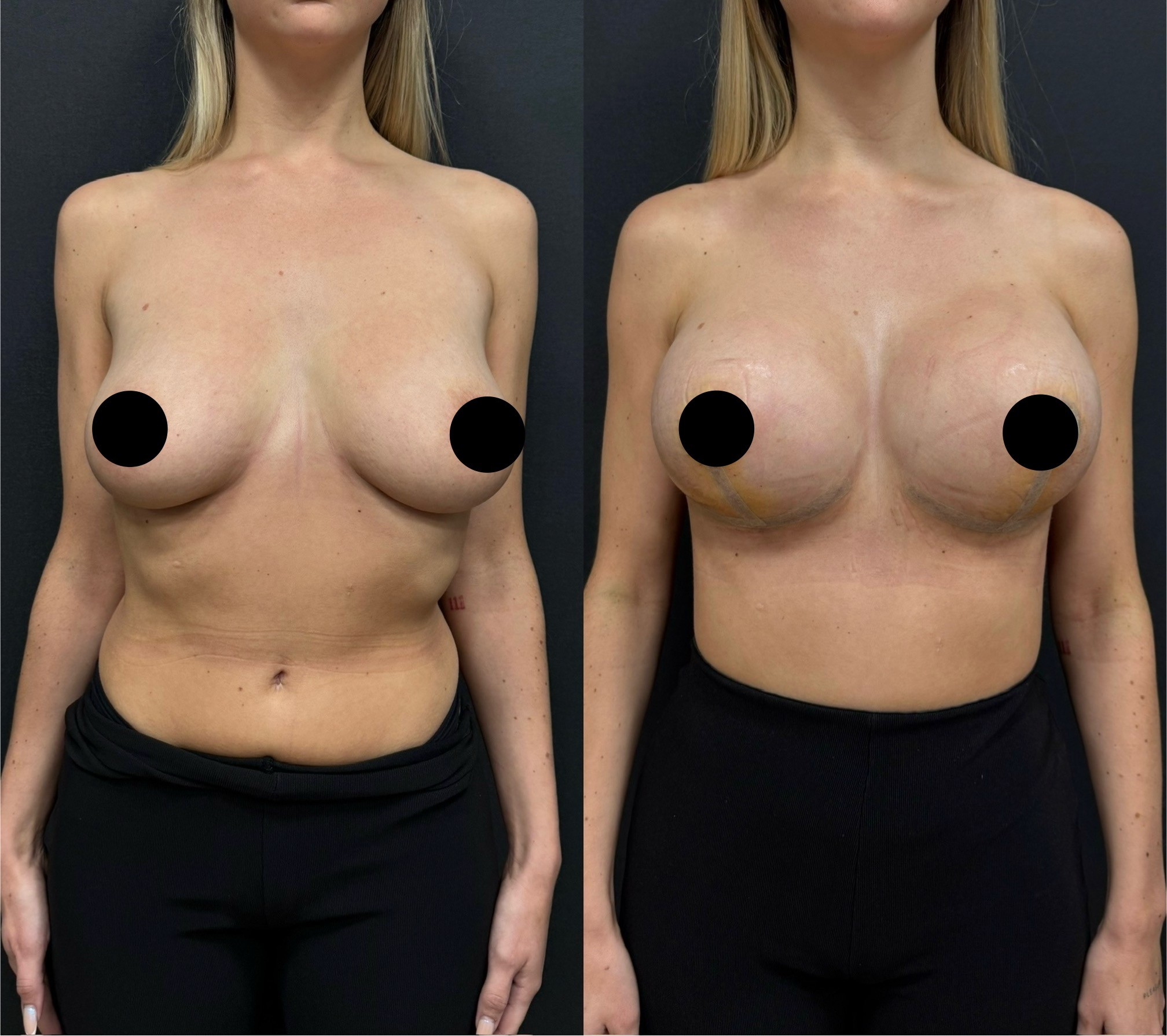 breast lift with implant before after 5 days result front view