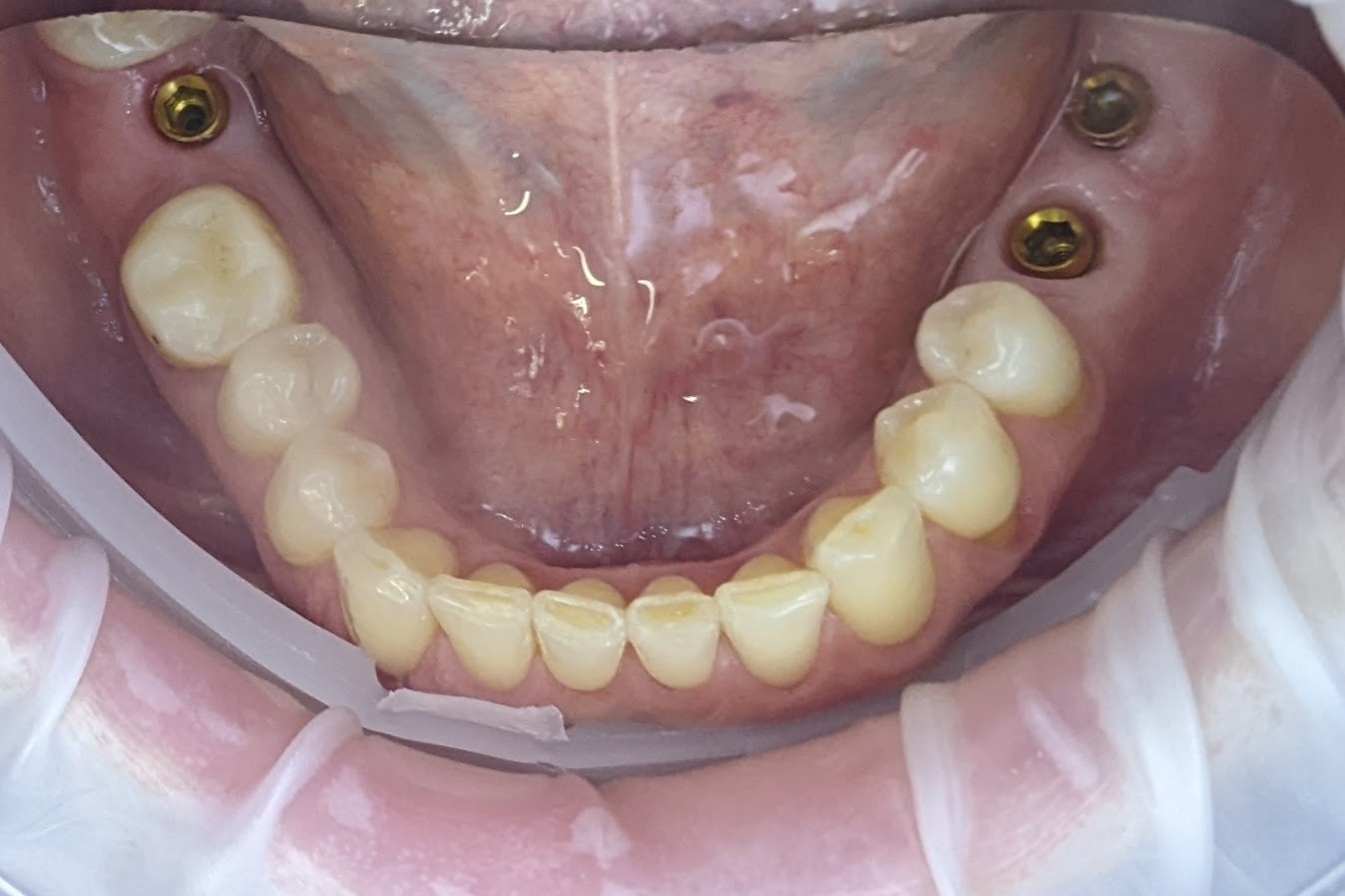 Fogászati Implantátum Tájékoztató