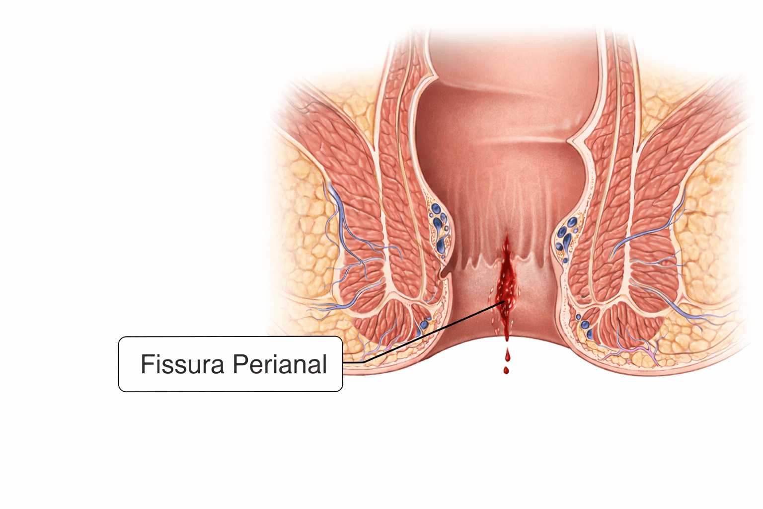 fissura perianal crônica