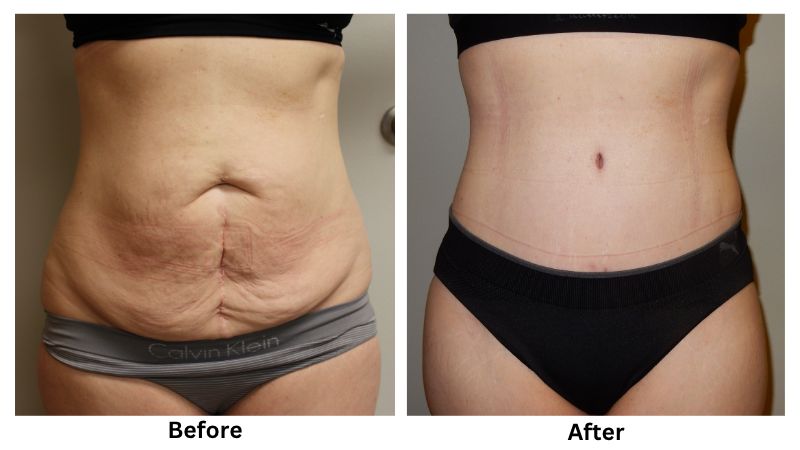 Before and after of surgery image