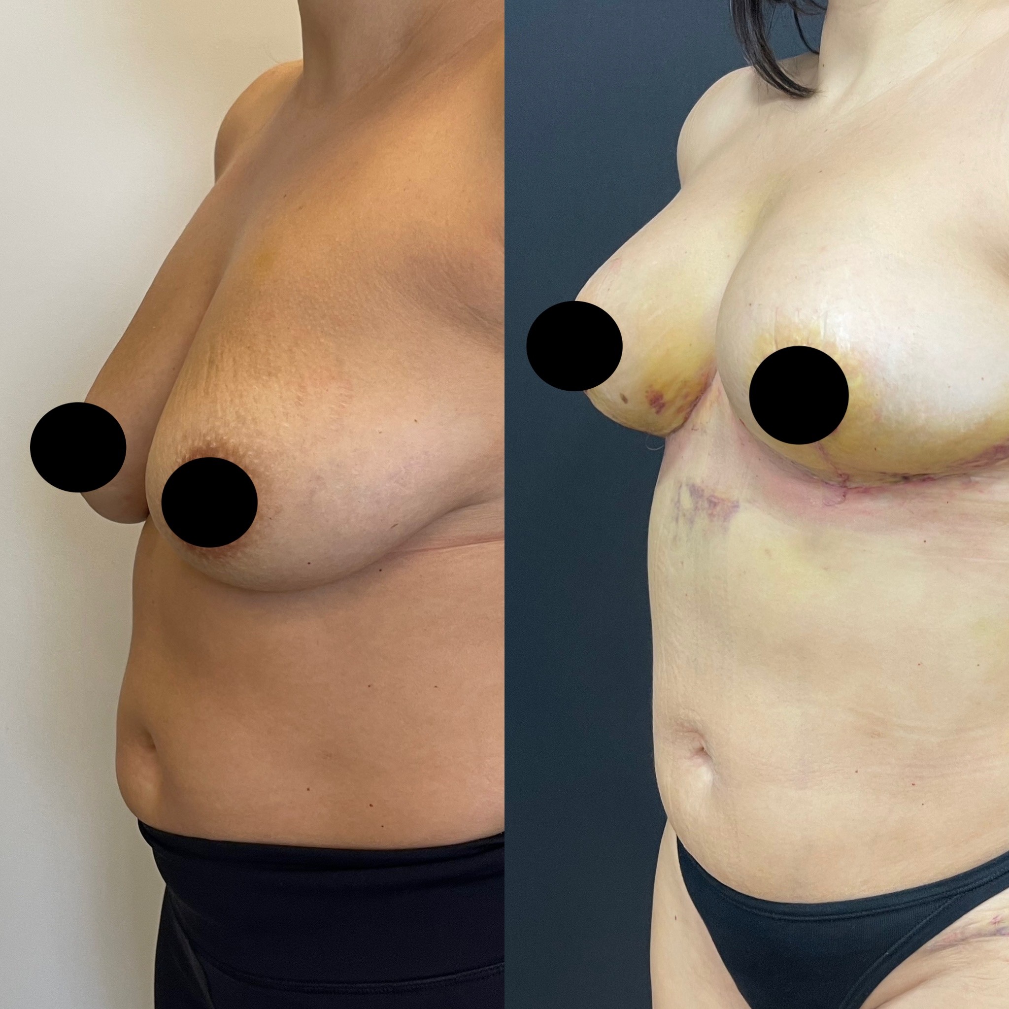 breast lift internal bra technique before after side view