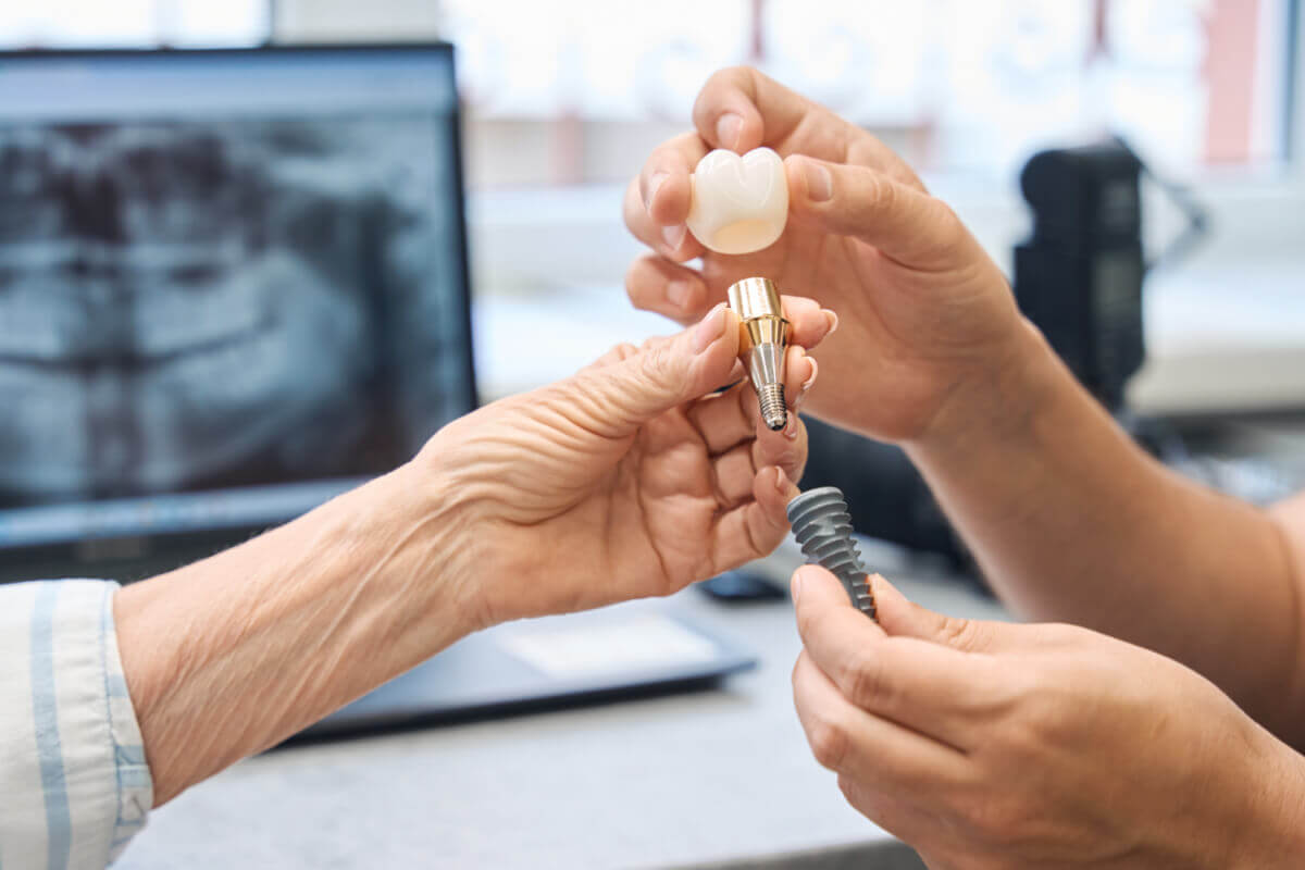 Implantes Dentários