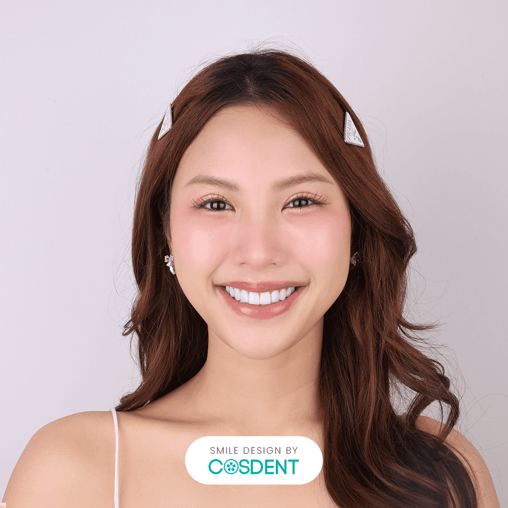 รูปไข่ 20 ซี่ หลังทำวีเนียร์