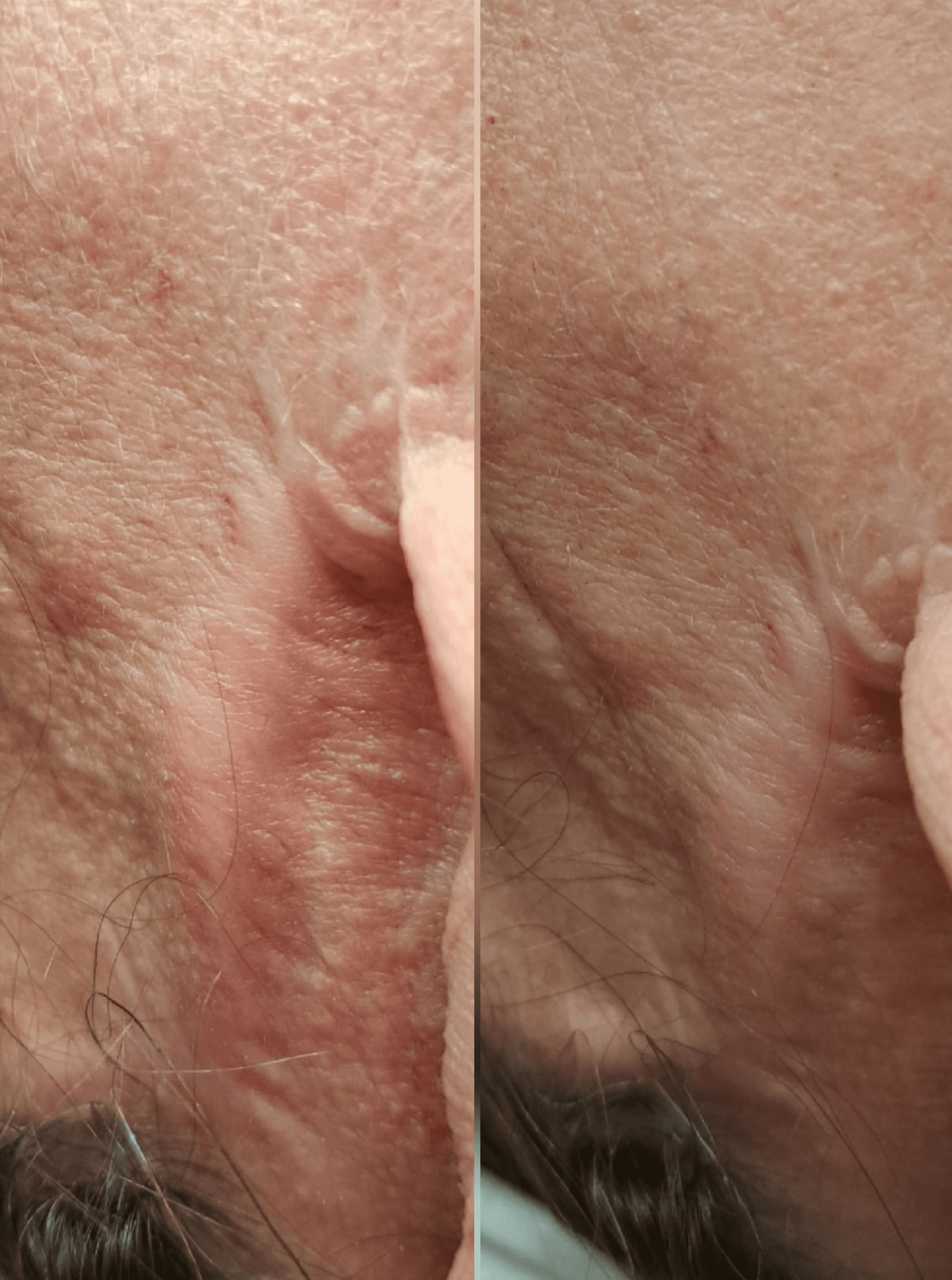 Neuroscars neurolifting_neurorehabiltacja_szczecin_wrocÅaw_estGen_leszczenko_efekt_jednego_zabiegu