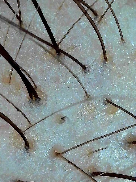 Microscopic close-up of an oily, congested scalp with mild irritation before treatment