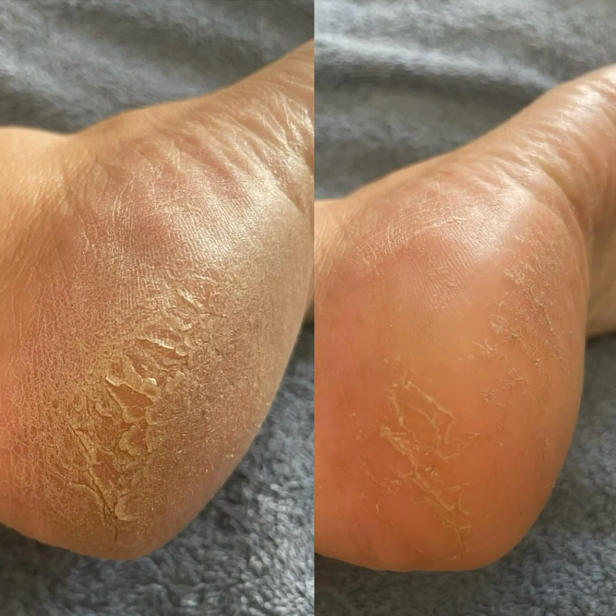 Before and after treatment - hand