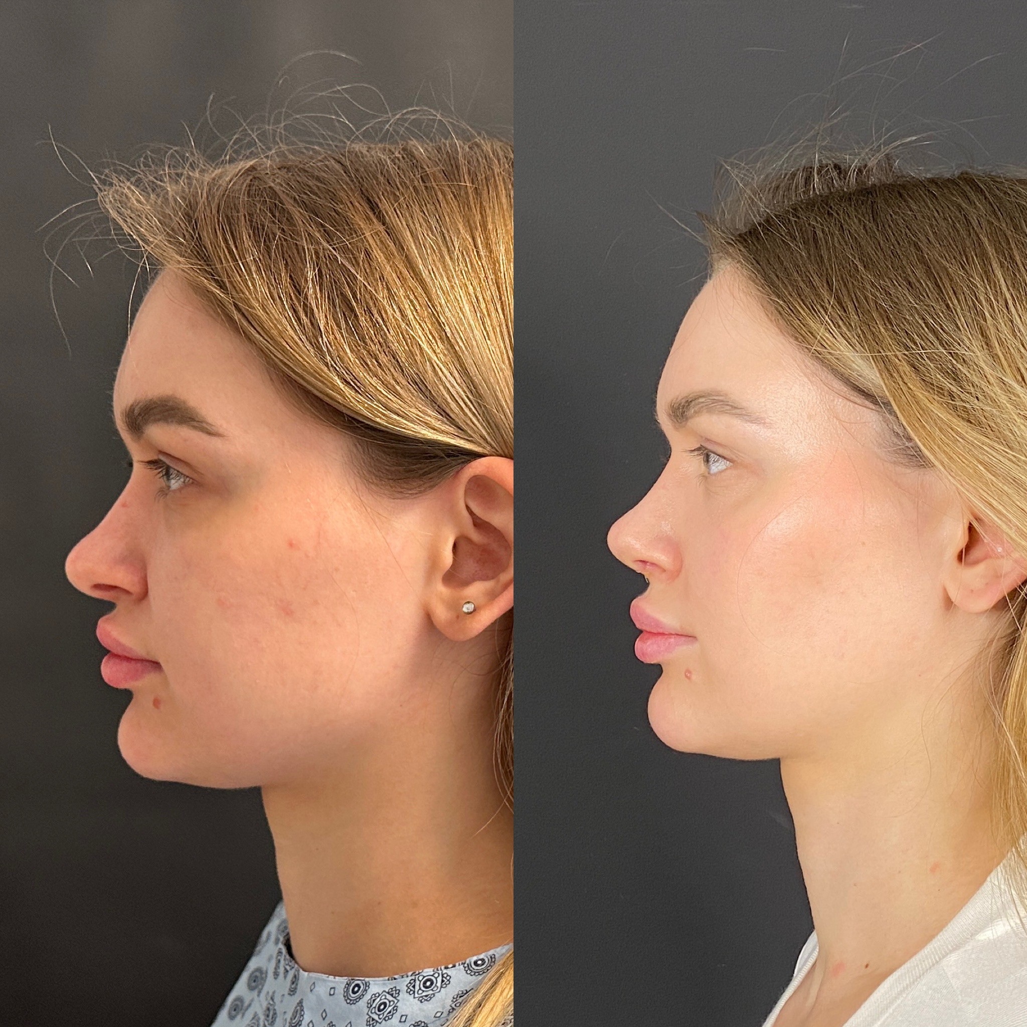 5 days cast removal of rhinoplasty before after side view