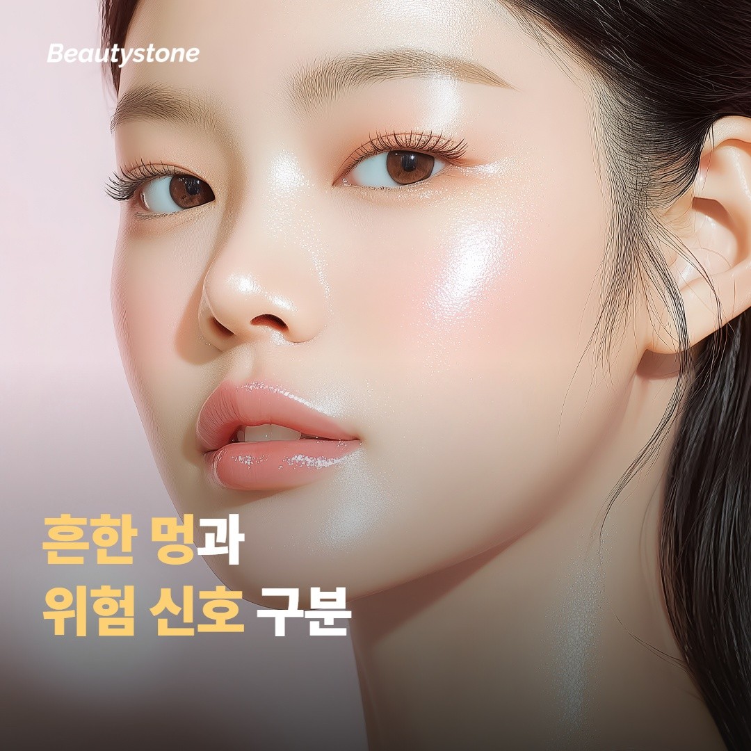 흔한 멍과 병원에 연락할 신호 구분하기