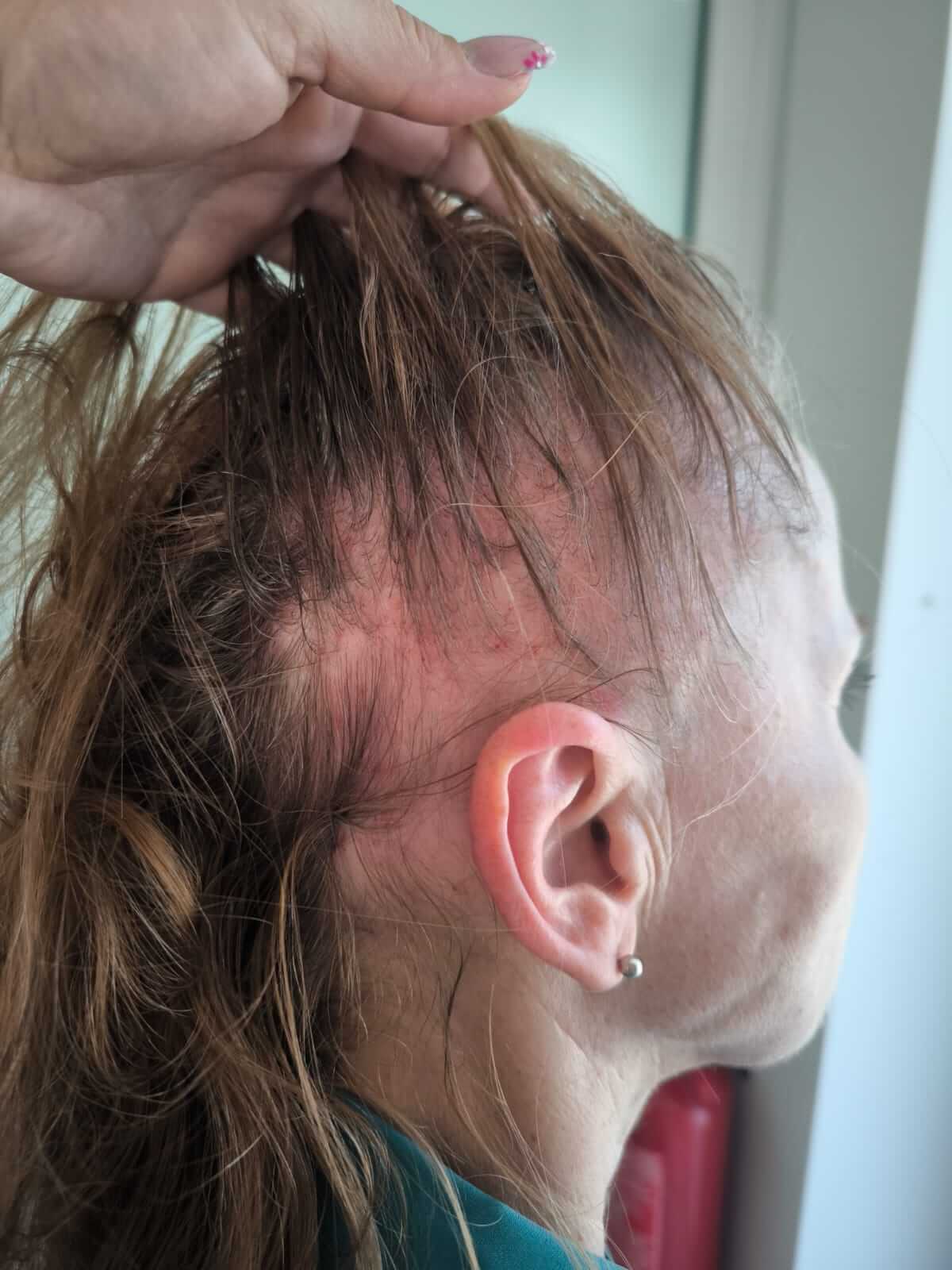 Fotografia vlasovej mezoterapie na začiatku cyklu 6 ošetrení.