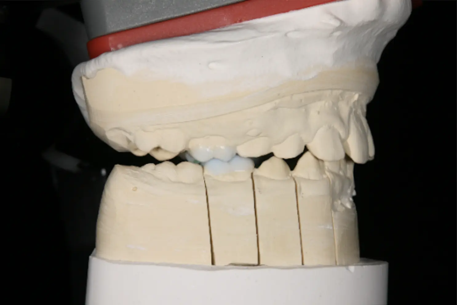 Wax-up-Entwurf der zukünftigen Onlays mit einem speziellen Mechanismus, der den Unterkiefer in eine  grundlegend bessere physiologische Position bringt. Dieser Ansatz entlastet die Kiefergelenke (TMJs)  und fördert ein gesundes Wachstum der Kiefer sowie der Gesichts- und Schädelknochen.