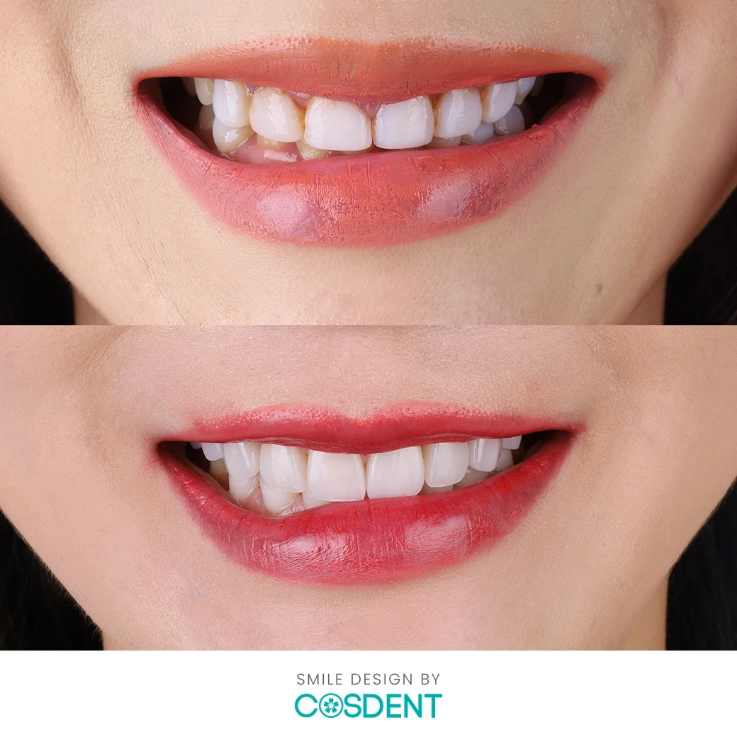 รีวิวออกแบบรอยยิ้ม ที่ cosdent smile design
