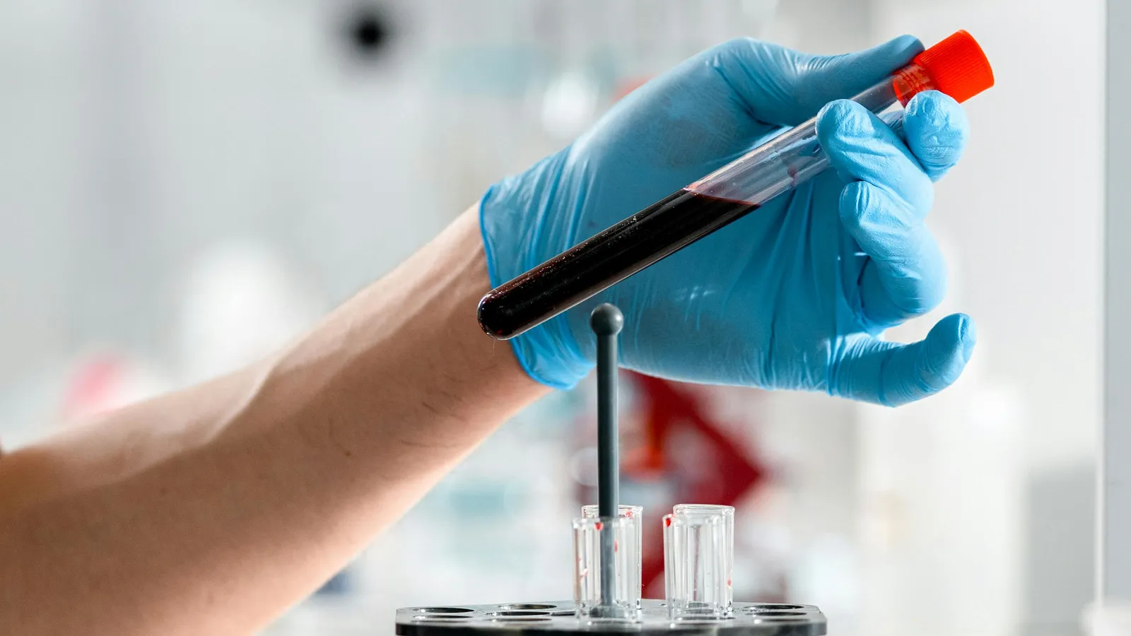 What Is Urobilinogen?