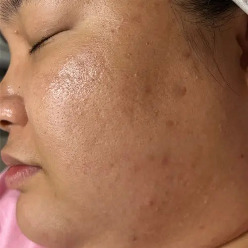 After acne scar and pigmentation treatment at The Vancouver Aesthetician — pitted scars resolved, dark marks faded and skin visibly spotless and smooth