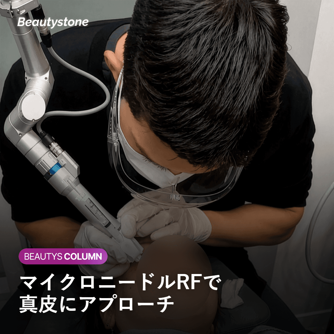 ポテンツァとは——マイクロニードルRFの仕組み
