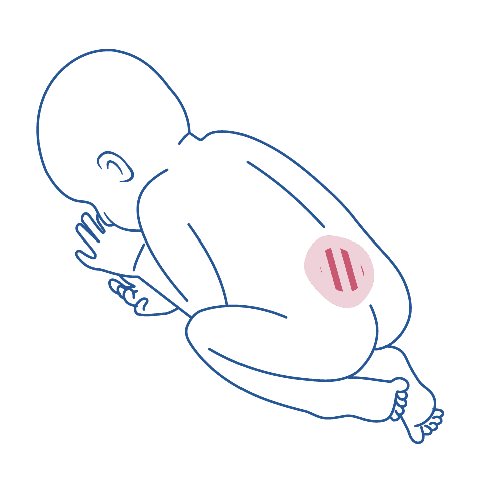 Ilustração em linhas azuis mostrando um bebê recém nascido encolhido, com as costas aparentes e a região da lombar marcada, mostrando a área onde há maior incidência de mielomeningocele