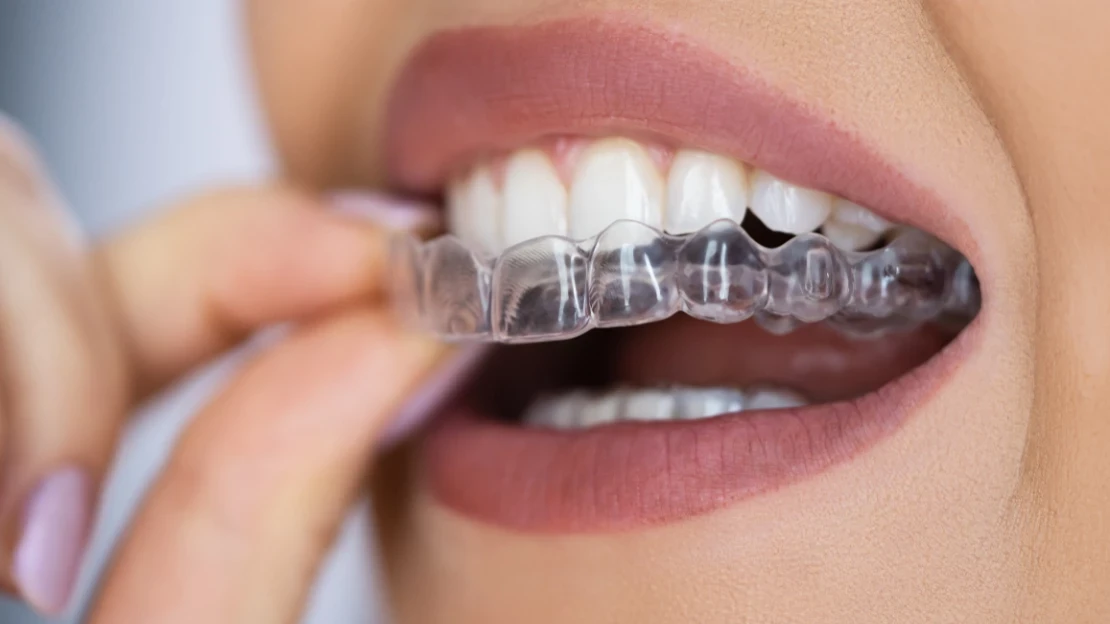 Invisalign Clear Aligners