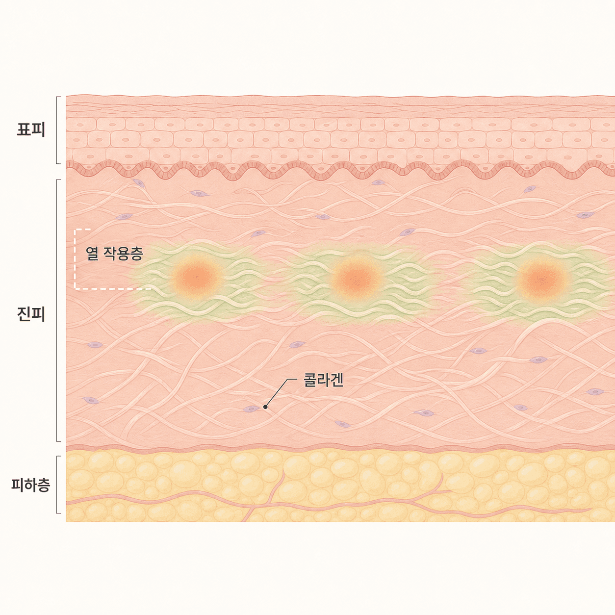 표피를 보존한 채 진피 얕은 층에 작용하는 소프웨이브의 열 작용층
