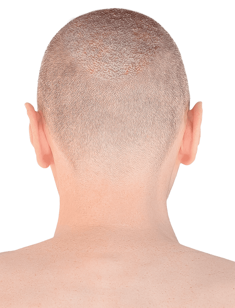 Hair transplantation with advanced techniques