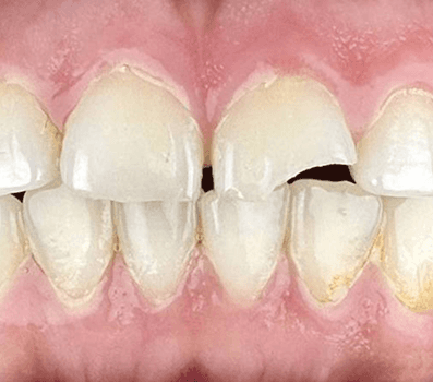 Tooth Colored Anterior Fillings - Before