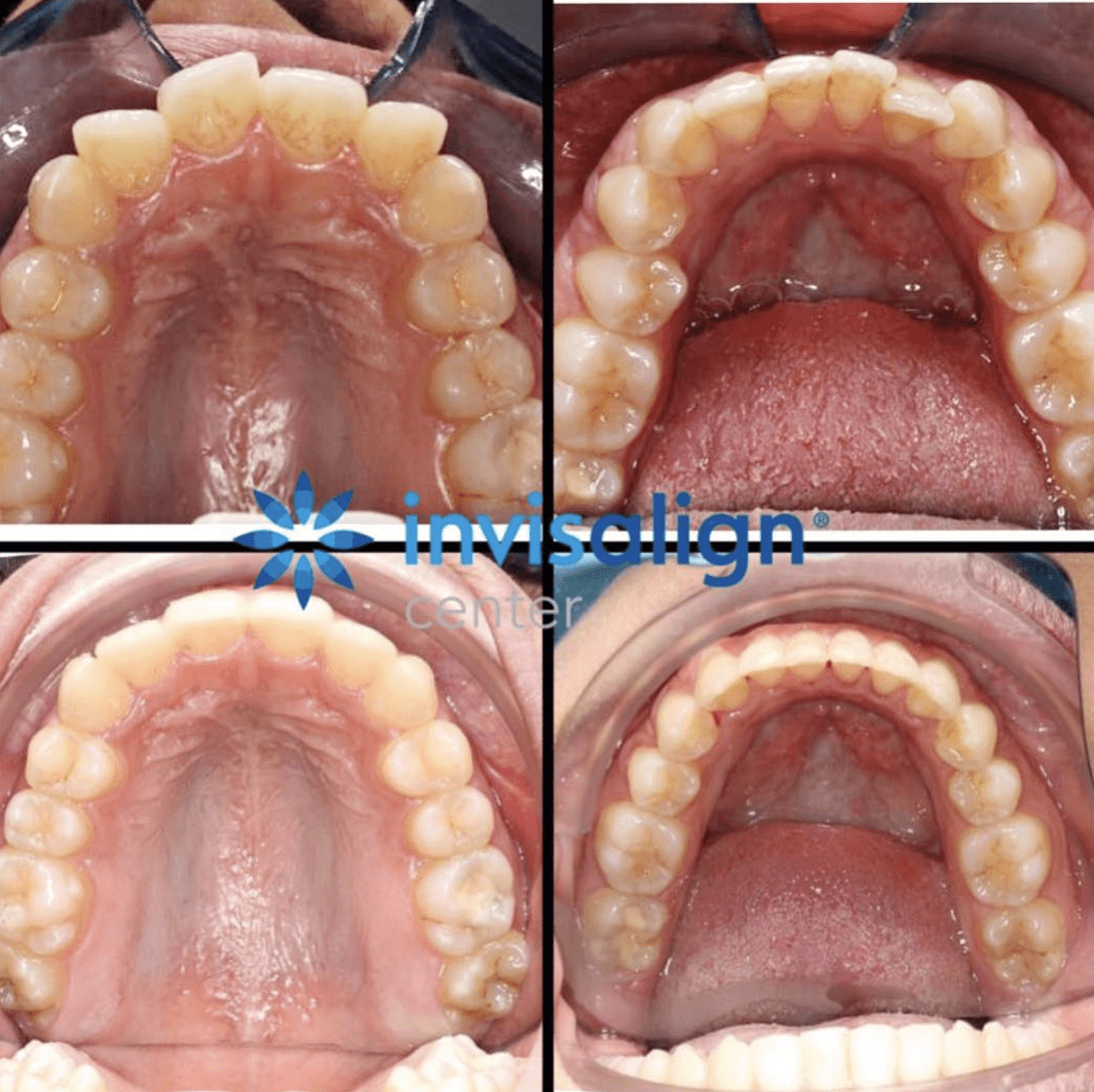 Invisalign® before and after photo from Invisalign Center in Dubai showing a clear transformation and correction of an open bite.
