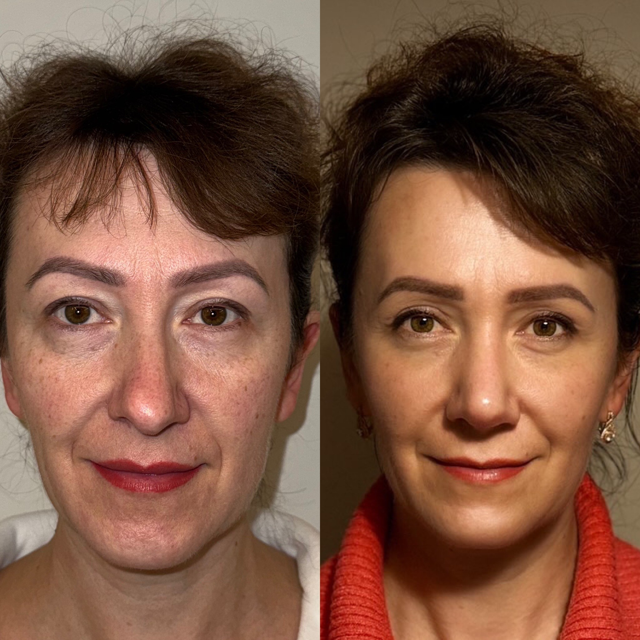 1 month after revision rhinoplasty before after front view