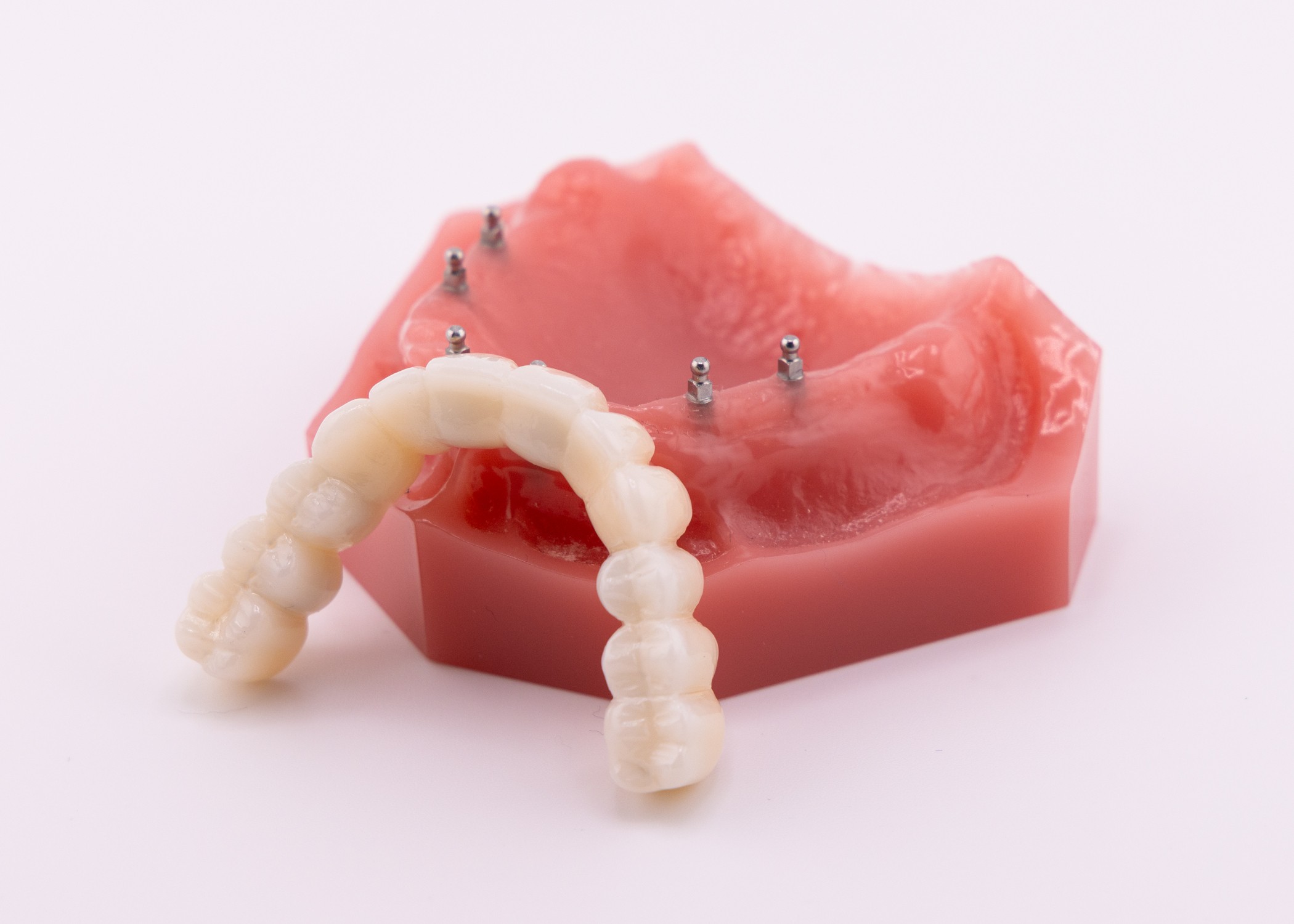 Mini Dental Implants