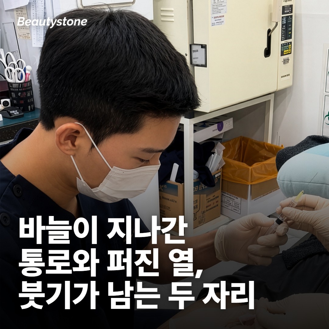 포텐자 붓기는 바늘과 열이 같이 들어간 자리에 남아요