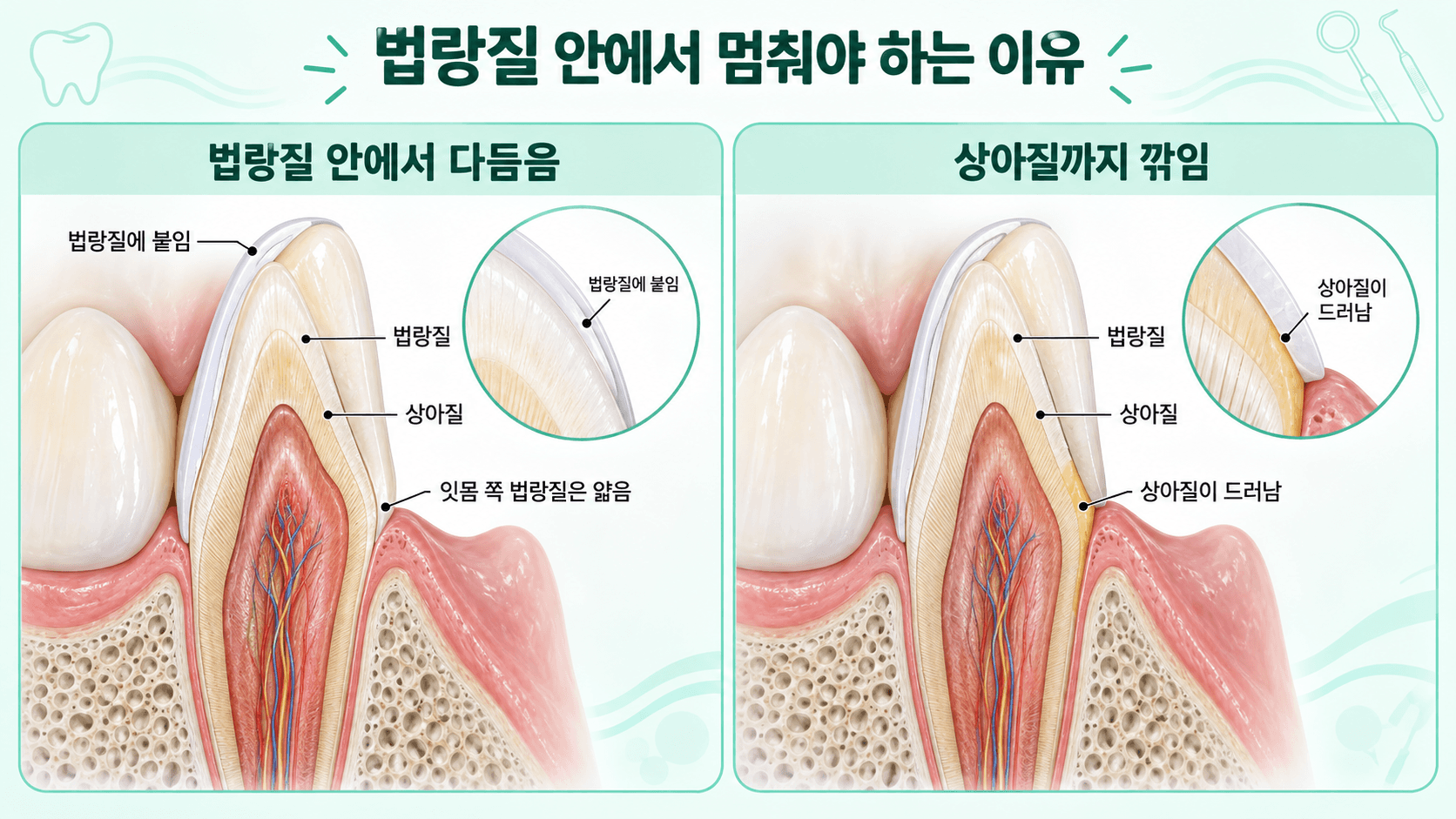 앞니 단면에서 잇몸 쪽 법랑질이 얇아 조금만 더 깎아도 상아질이 드러나는 모습을 법랑질 안에서 다듬은 경우와 비교한 일러스트