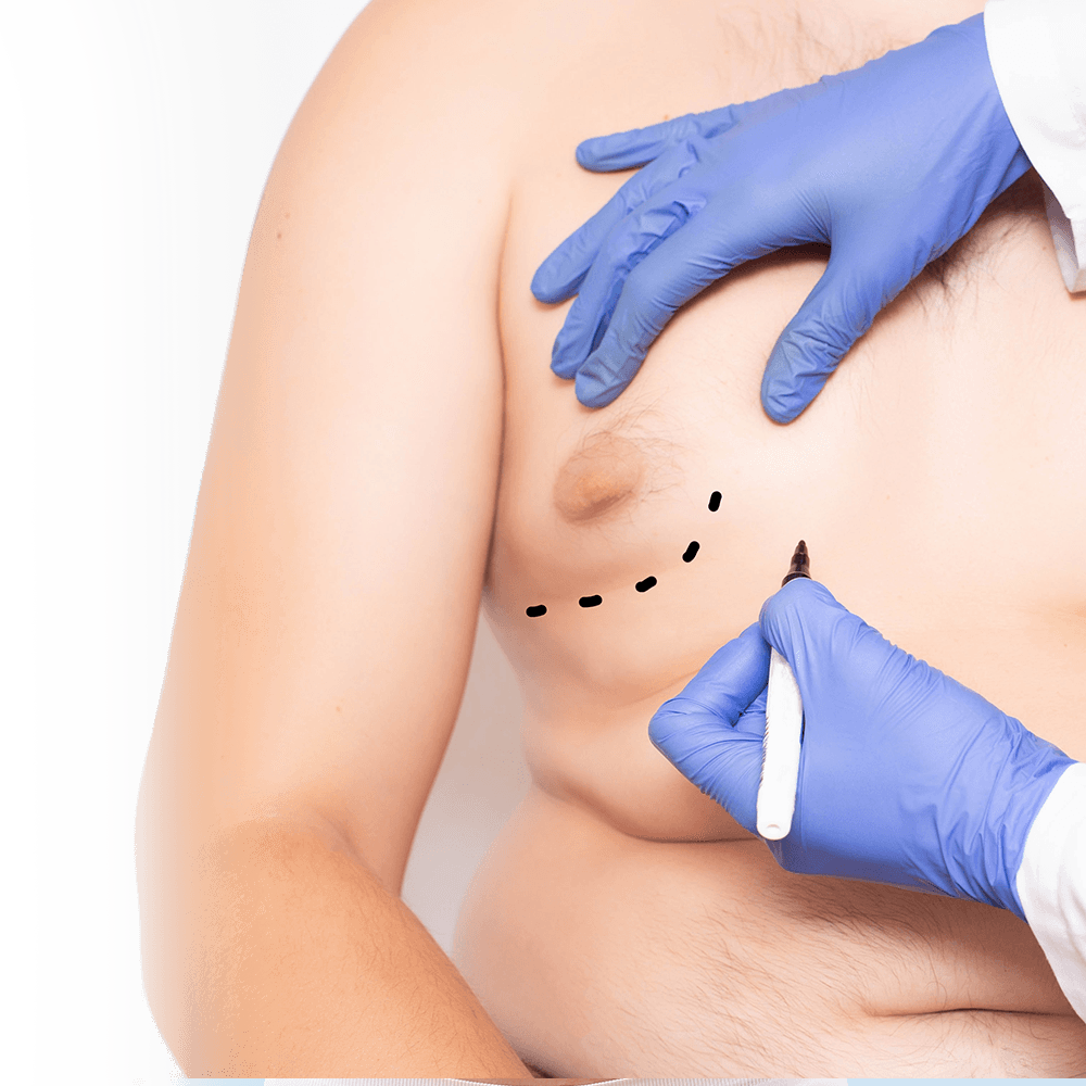 surgical planning of gynecomastia