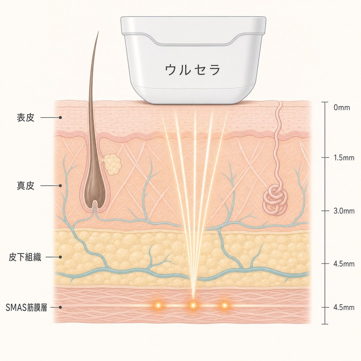 ウルセラの集束超音波が表皮を通り越してSMAS筋膜層に熱を届けるイメージ
