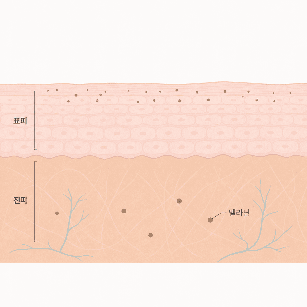 표피에 얕게 뜬 색소와 진피에 가라앉은 색소의 깊이 차이