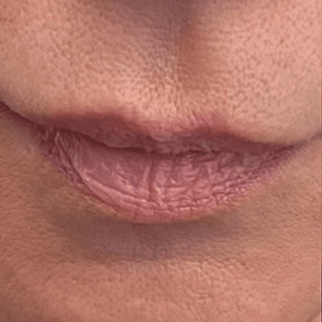 Dermal Fillers before