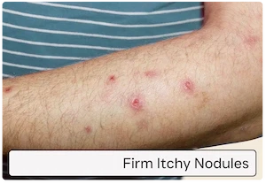 Firm, itchy nodules
