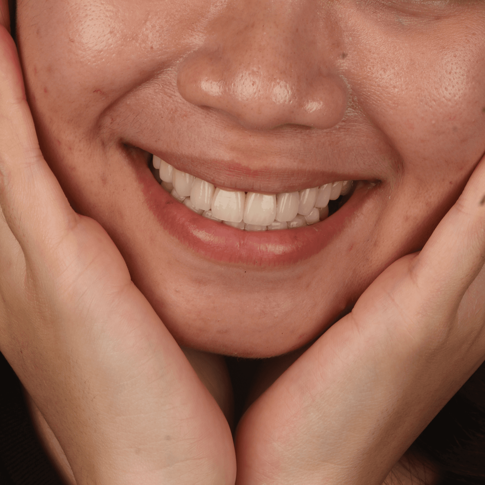 Close-up of a bright, white smile showcasing cosmetic dentistry services including veneers and teeth whitening at Ora Dental.