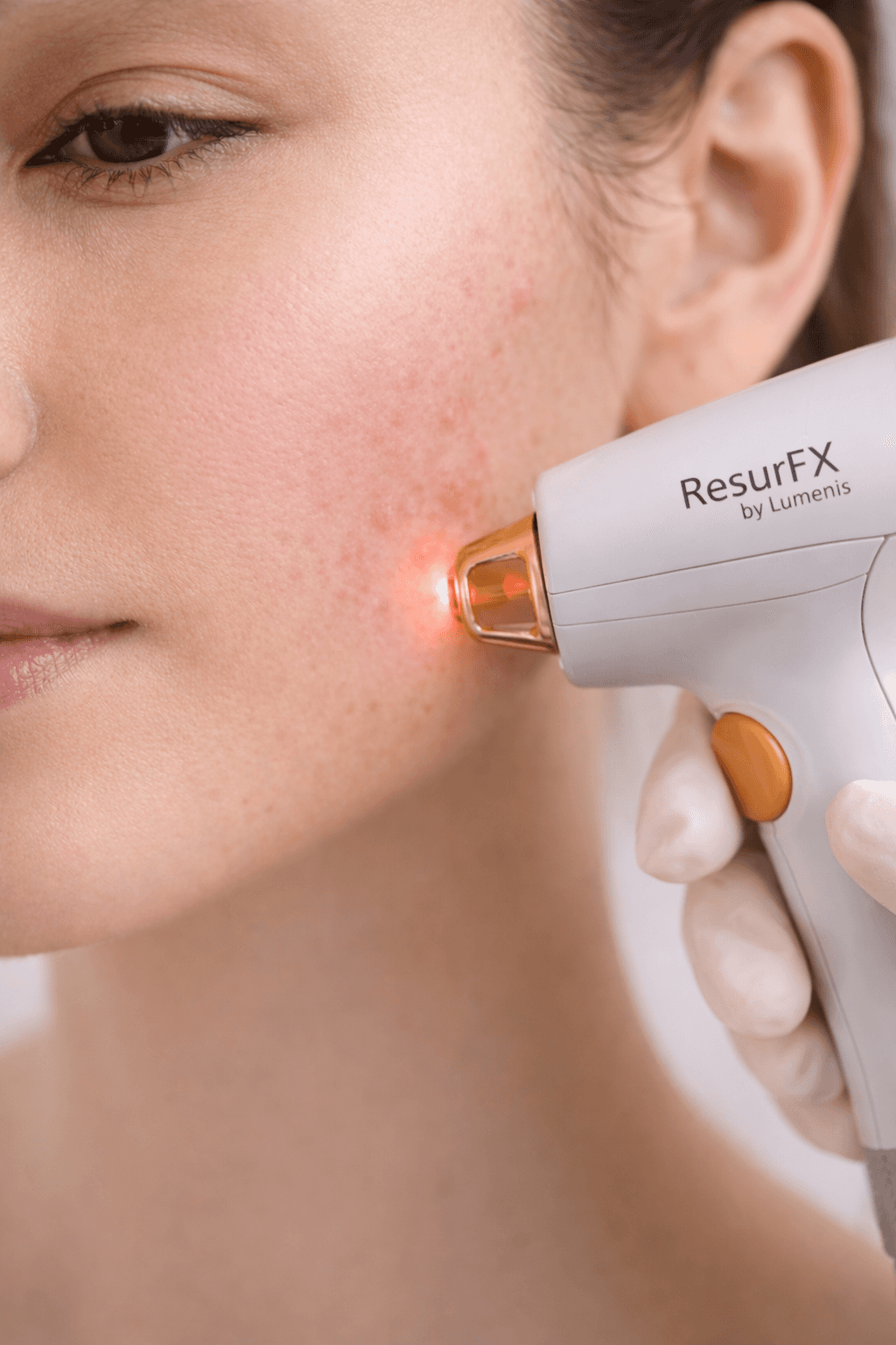 The Benefits of Chemical Peels