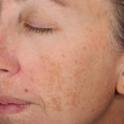 After brightening treatment at The Vancouver Aesthetician — melasma and sun damage significantly reduced with visibly brighter and more uniform skin tone