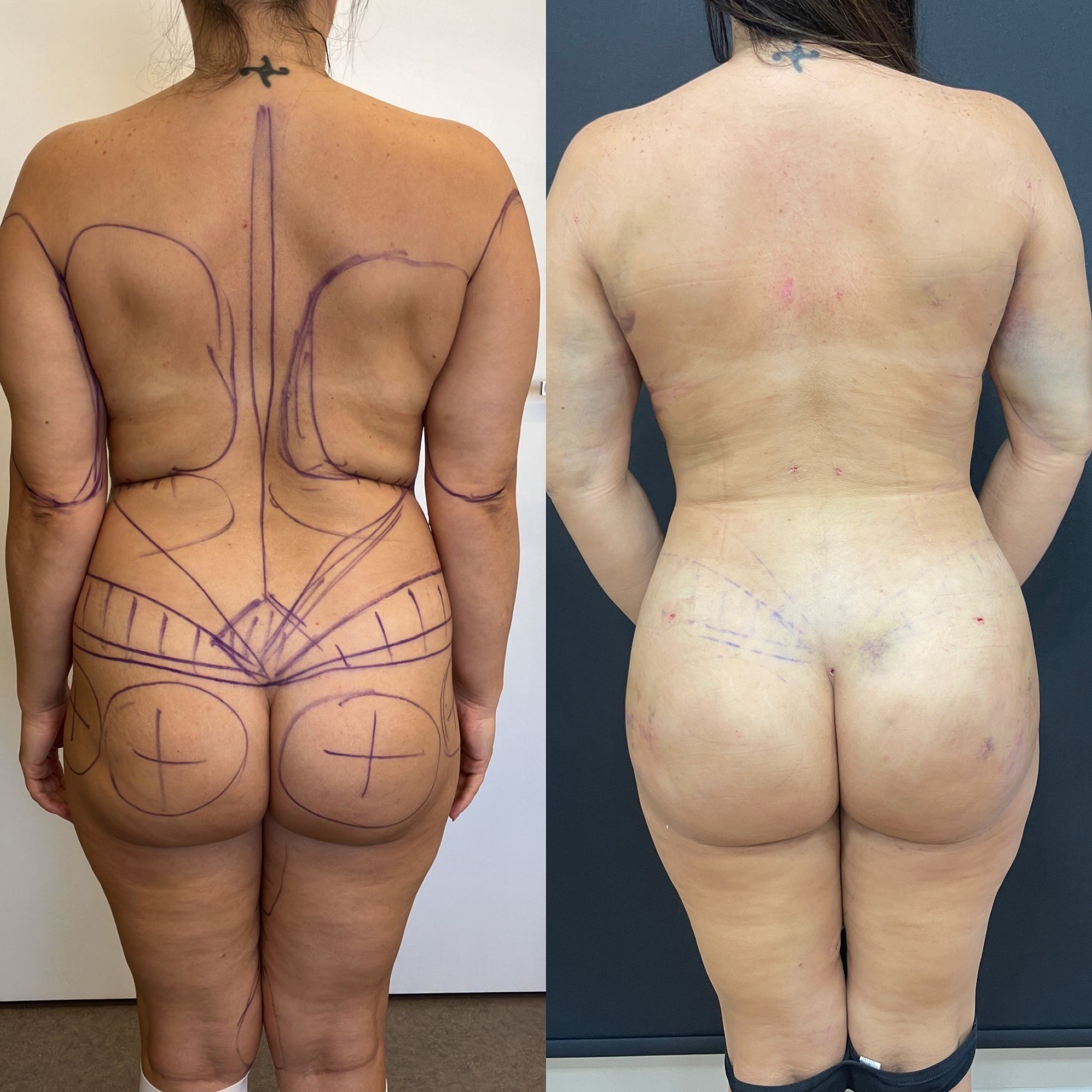 before after of vaser liposuction laser skin tightening and fat injection to buttocks patient (natural BBL)