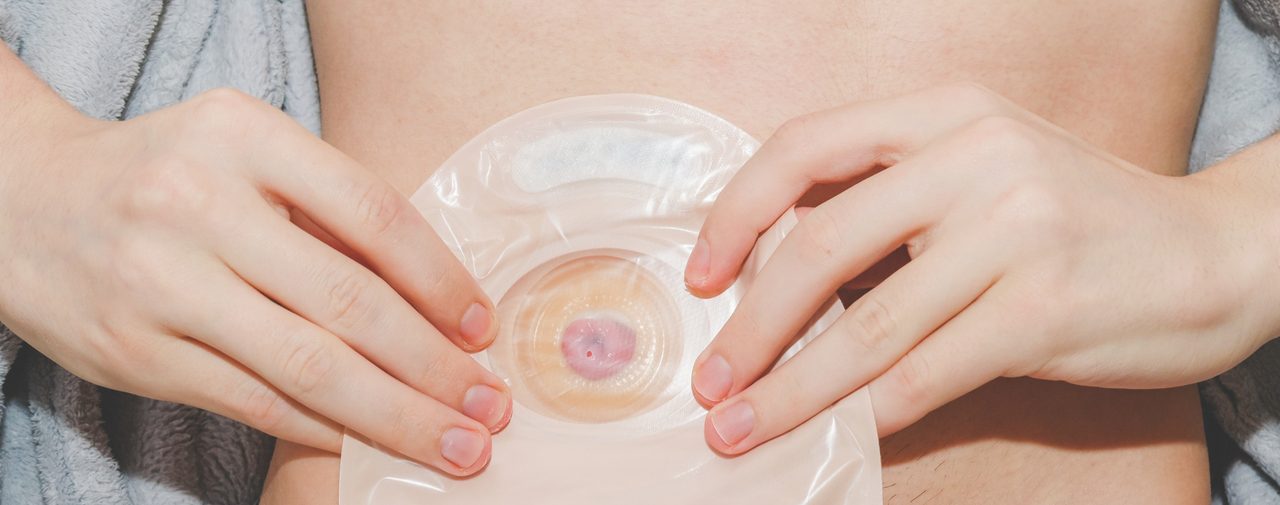 Stoma Care (NDIS) module cover