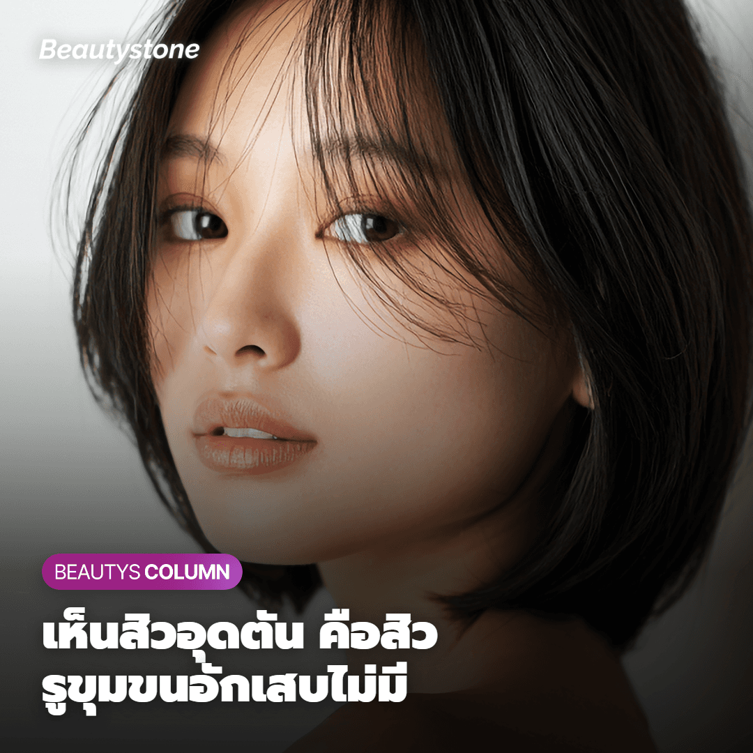 หากมองเห็น Comedone แสดงว่าเป็นสิวครับ