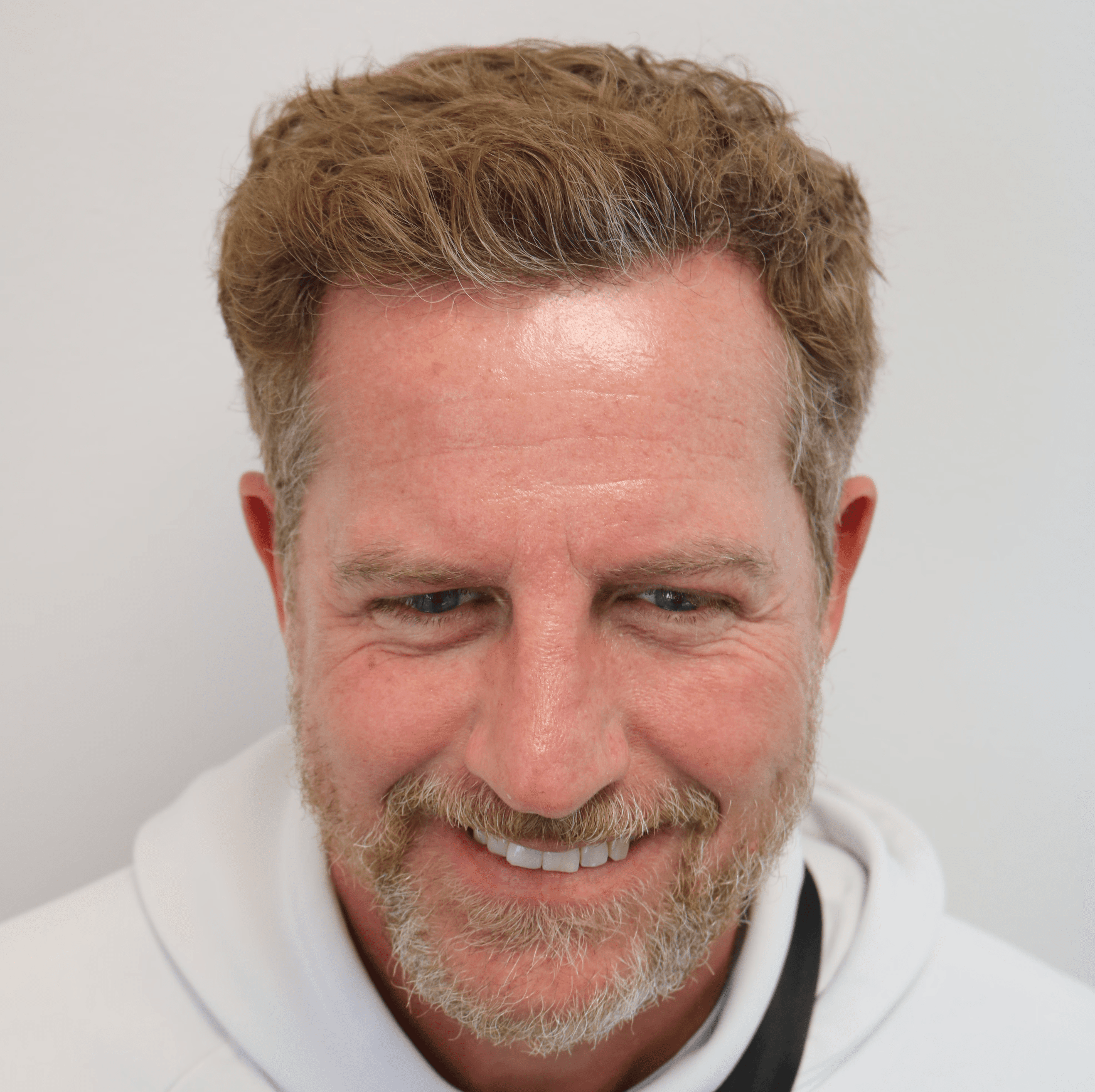 After hair transplant – Alistair's Result