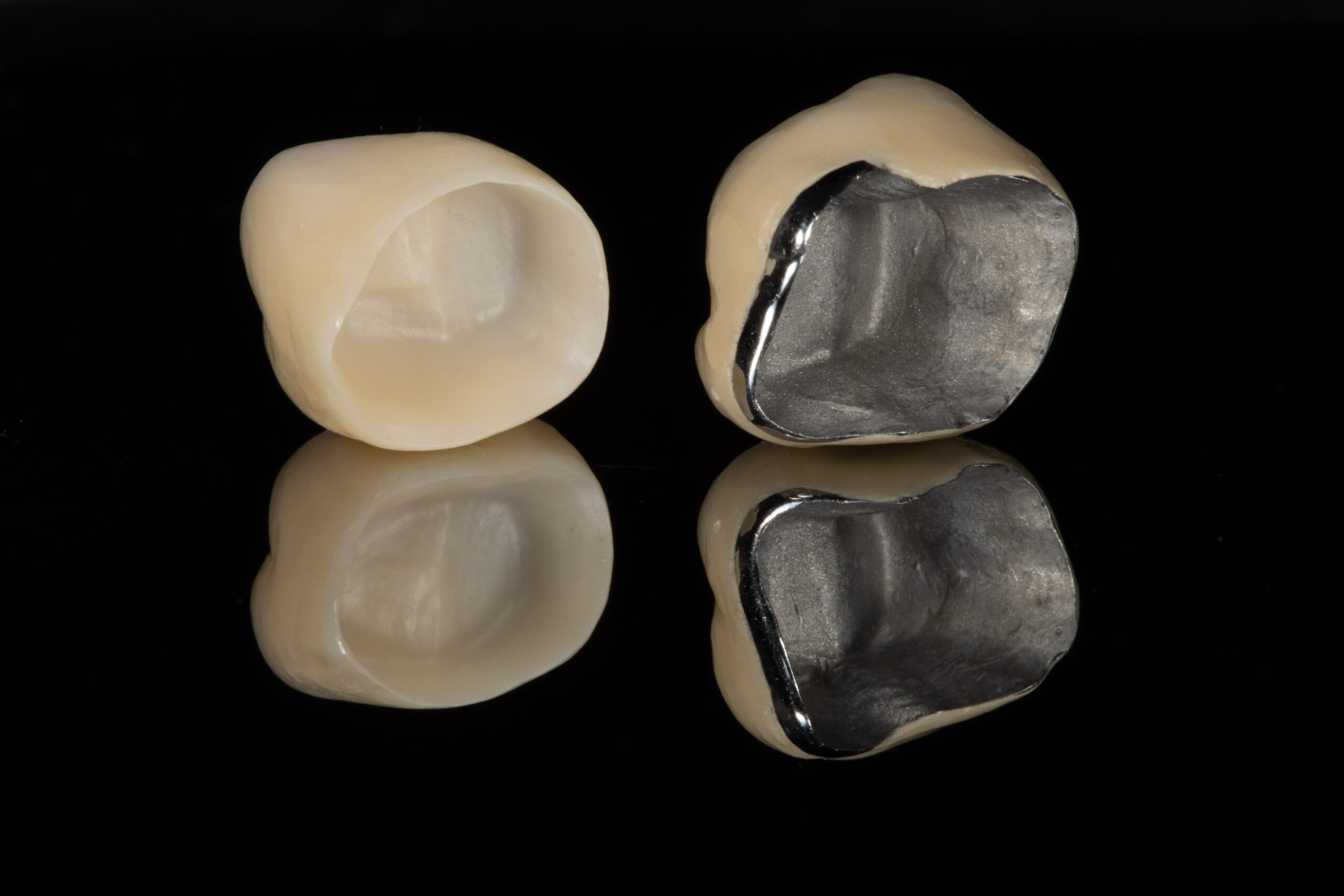 doctor in dental clinic davao matina showing porcelain fused to metal crown
