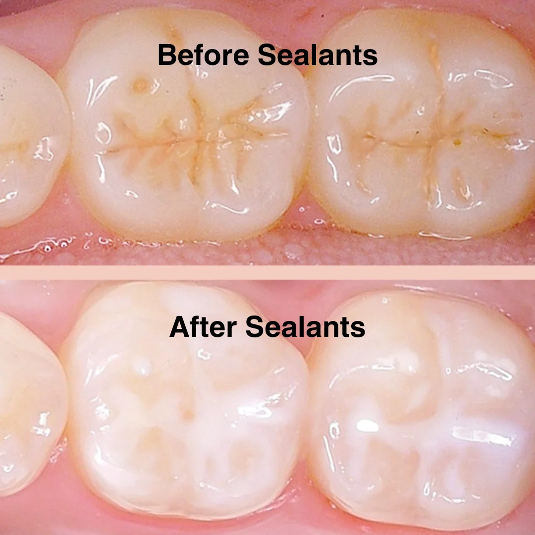 Childrens Dental Sealants SN Family Dental Newark Milltown NJ